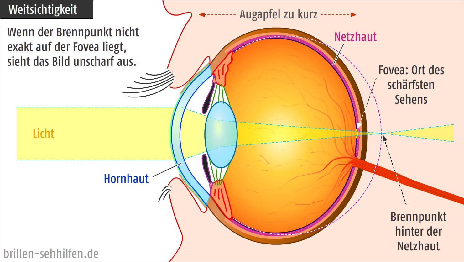 Ametropie pour Das Auge Des Menschen