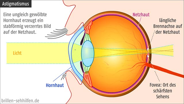 Astigmatismus, Stabsichtigkeit (Auge) tout Arbeitsblatt Bestandteile Des Auges